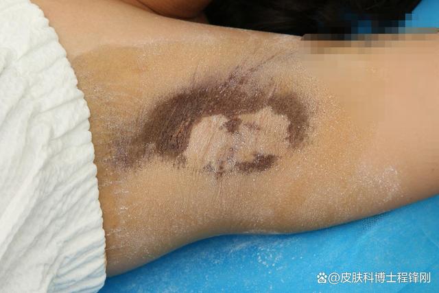 狐臭微创治疗