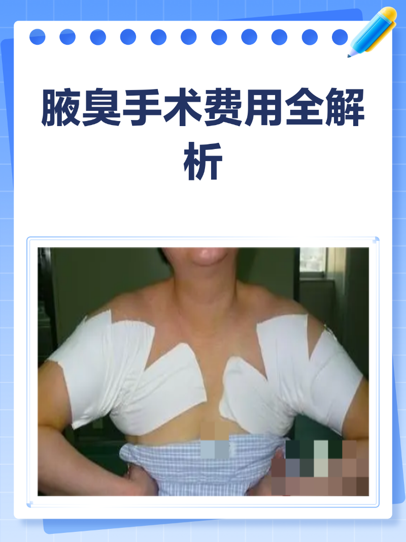 腋臭手术费用