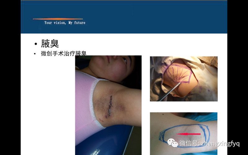 湖南附大腋臭专科:长沙狐臭人群就医选择与诊疗要点解析